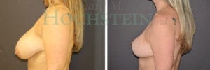 Breast Reduction/Lift (No Implants) Patient