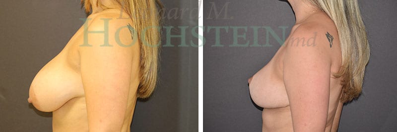 Breast Reduction/Lift (No Implants) Patient