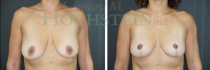 Breast Reduction/Lift (No Implants) Patient