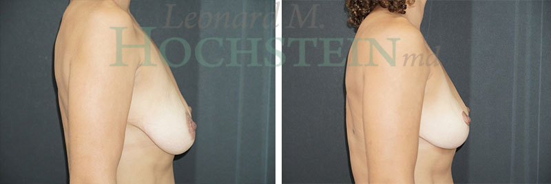 Breast Reduction/Lift (No Implants) Patient