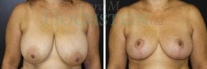 Breast Reduction/Lift (No Implants) Patient