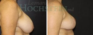 Breast Reduction/Lift (No Implants) Patient