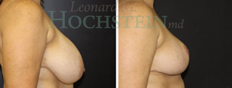 Breast Reduction/Lift (No Implants) Patient