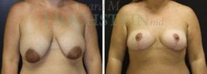 Breast Reduction/Lift (No Implants) Patient