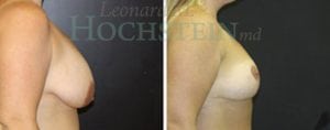 Breast Reduction/Lift (No Implants) Patient