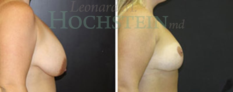 Breast Reduction/Lift (No Implants) Patient