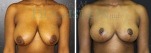 Breast Reduction/Lift (No Implants) Patient