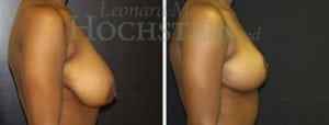 Breast Reduction/Lift (No Implants) Patient