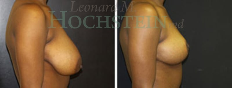 Breast Reduction/Lift (No Implants) Patient