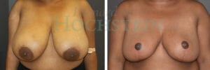 Breast Reduction/Lift (No Implants) Patient