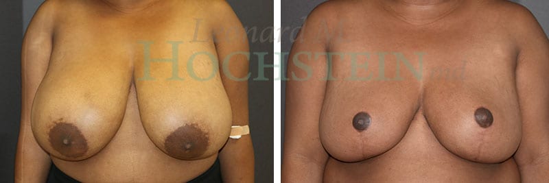 Breast Reduction/Lift (No Implants) Patient