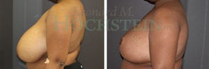 Breast Reduction/Lift (No Implants) Patient