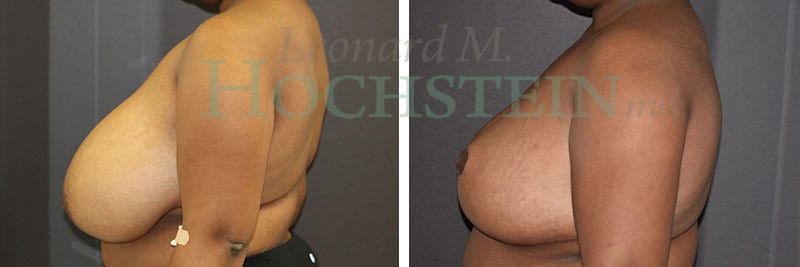Breast Reduction/Lift (No Implants) Patient
