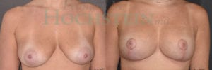 Breast Lift With Implants Patient