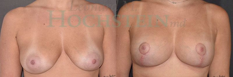 Breast Lift With Implants Patient