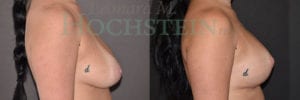 Breast Lift With Implants Patient