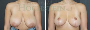 Breast Reduction/Lift (No Implants) Patient