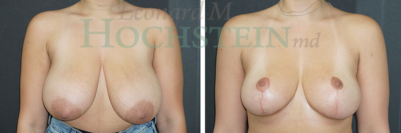 Breast Reduction/Lift (No Implants) Patient
