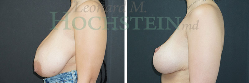 Breast Reduction/Lift (No Implants) Patient