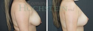 Breast Reduction/Lift (No Implants) Patient