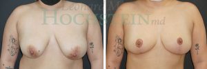 Breast Reduction/Lift (No Implants) Patient