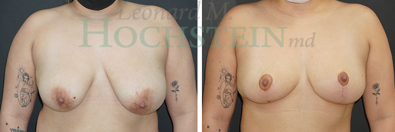 Breast Reduction/Lift (No Implants) Patient