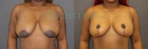 Breast Reduction/Lift (No Implants) Patient