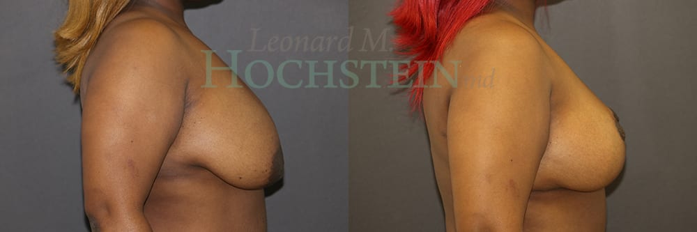 Breast Reduction/Lift (No Implants) Patient