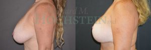 Breast Reduction/Lift (No Implants) Patient