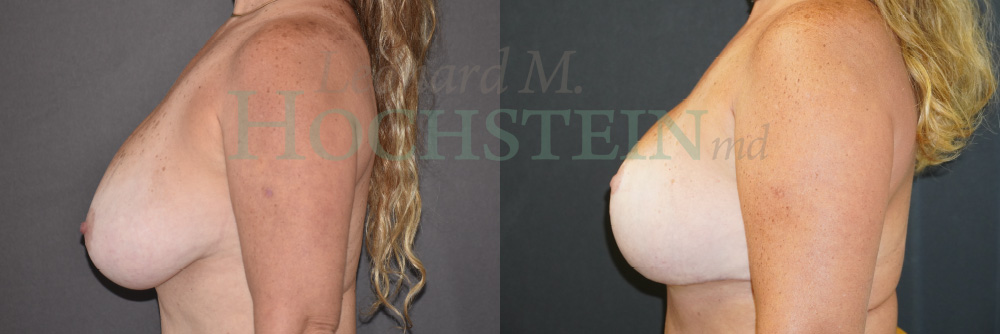 Breast Reduction/Lift (No Implants) Patient