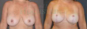 Breast Reduction/Lift (No Implants) Patient