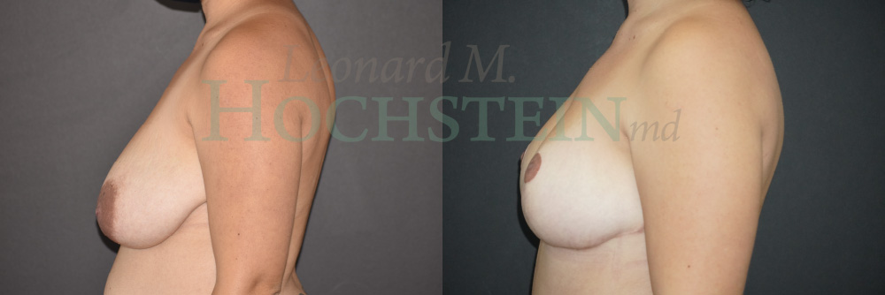 Breast Reduction/Lift (No Implants) Patient