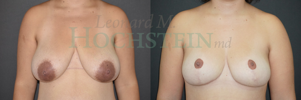 Breast Reduction/Lift (No Implants) Patient
