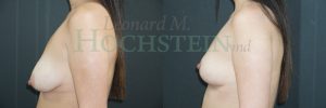 Breast Reduction/Lift (No Implants) Patient