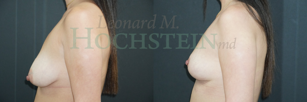 Breast Reduction/Lift (No Implants) Patient