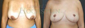 Breast Reduction/Lift (No Implants) Patient