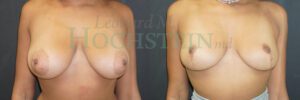 Breast Reduction/Lift (No Implants) Patient