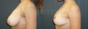 Breast Reduction/Lift (No Implants) Patient