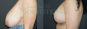 Breast Lift With Implants Patient