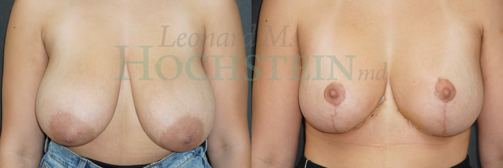 Breast Lift With Implants Patient