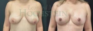 Breast Reduction Patient 35