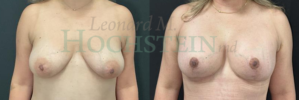 Breast Reduction/Lift (No Implants) Patient