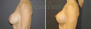 Breast Revision Patient