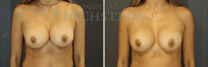 Breast Revision Patient