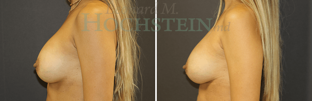 Breast Revision Patient