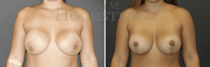 Breast Revision Patient
