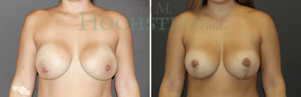 Breast Revision Patient