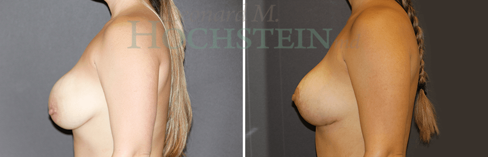 Breast Revision Patient