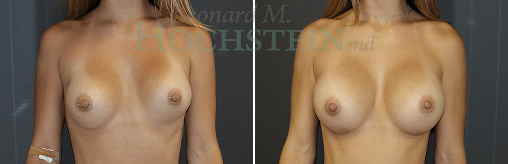 Breast Revision Patient
