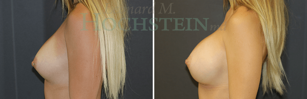 Breast Revision Patient